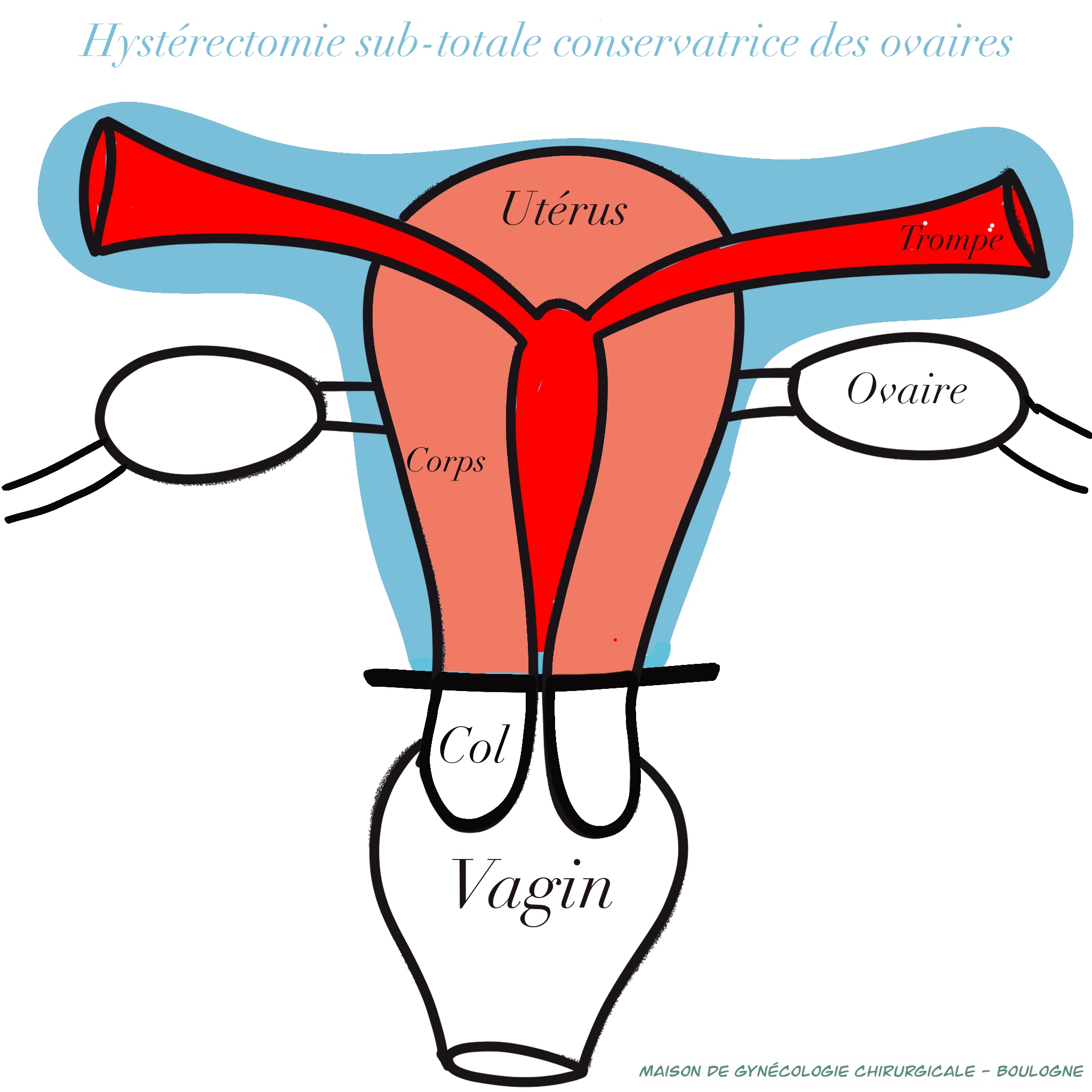 HYSTERECTOMIE Maison de Gynécologie Chirurgicale — free download